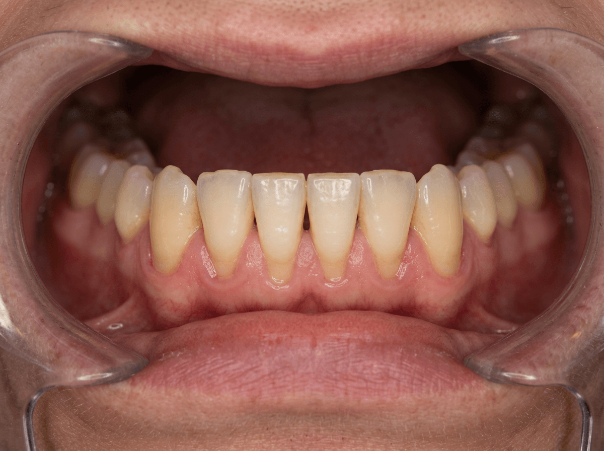 Before dental implant placement